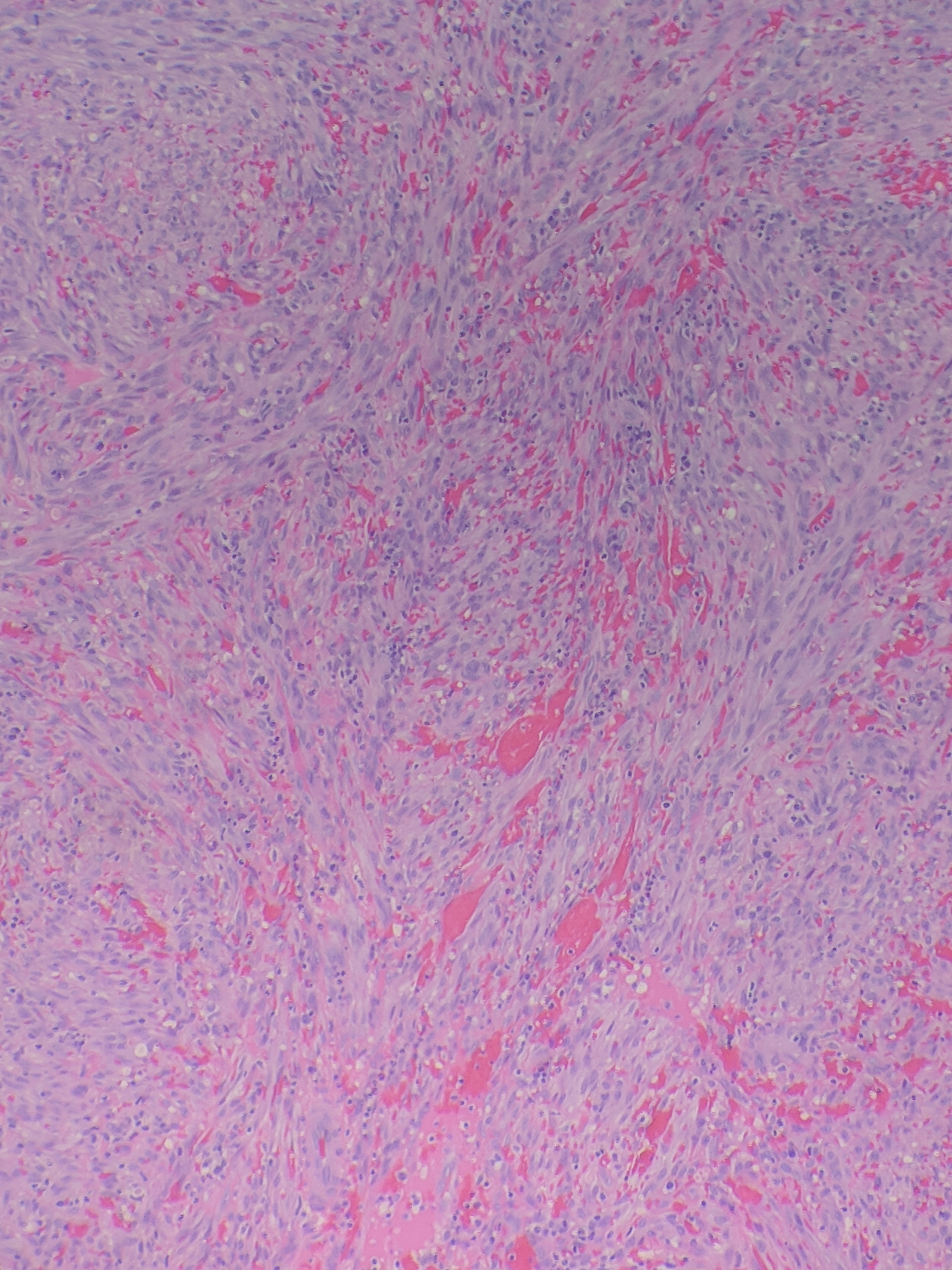 Histopathology of Kaposi sarcoma