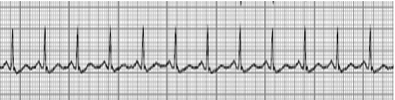 ECG hypercalcemia