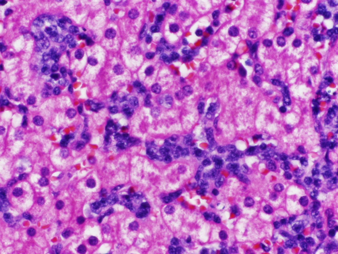 <p>Liver Biopsy