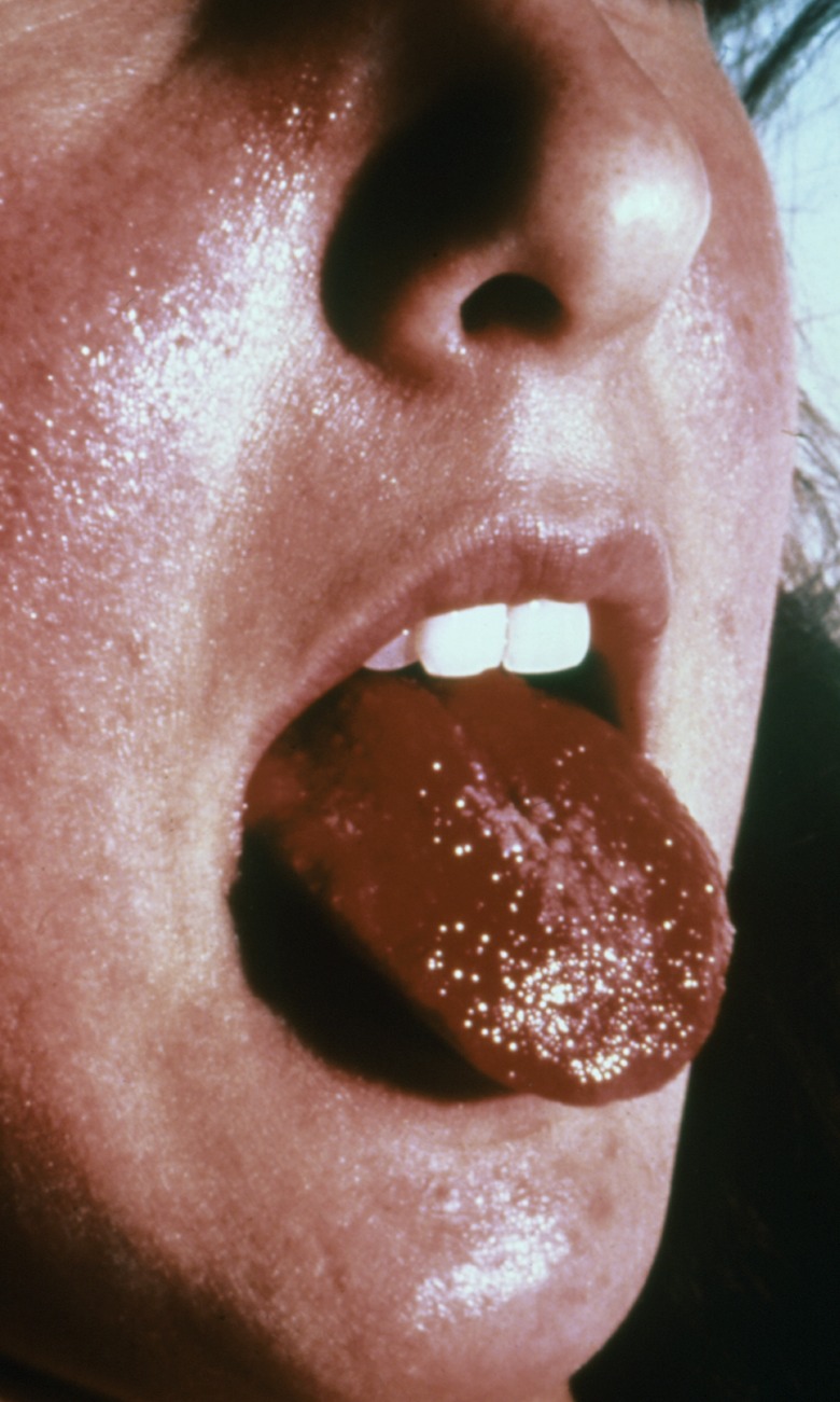 Strawberry Tongue. Image of strawberry tongue caused by S aureus in a patient with toxic shock syndrome.