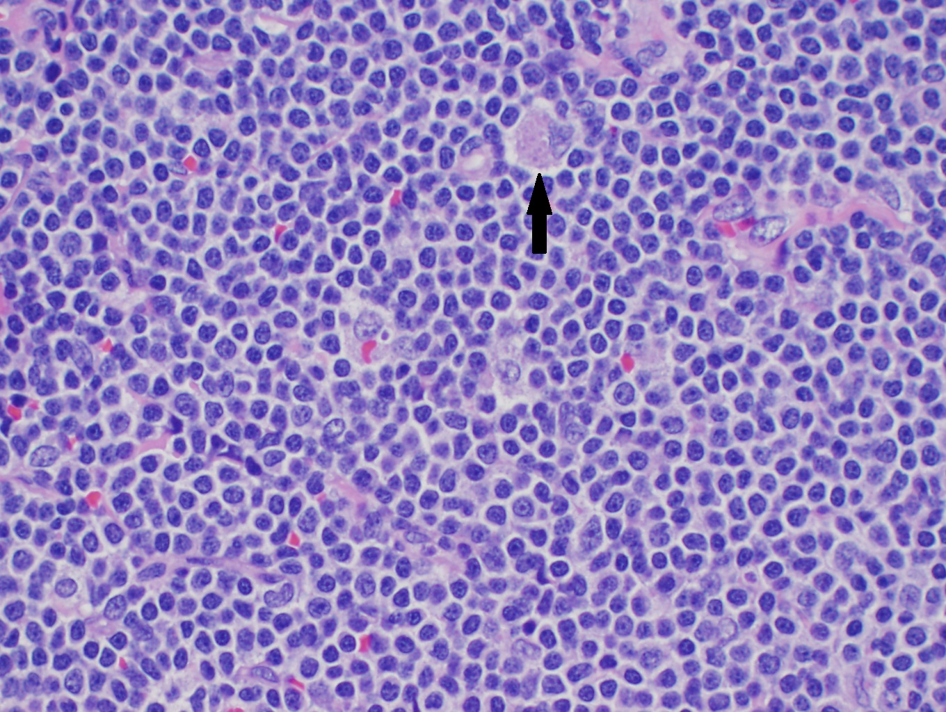 High power H&E of mantle cell lymphoma showing monotonous mature lymphocytes with mildly irregular nuclei