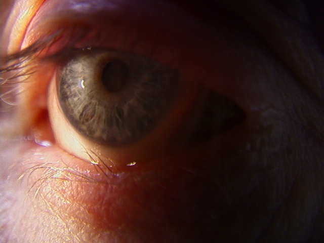 <p>Trichiasis. This image displays trichiasis at a site of prior trauma to the lower eyelid.</p>