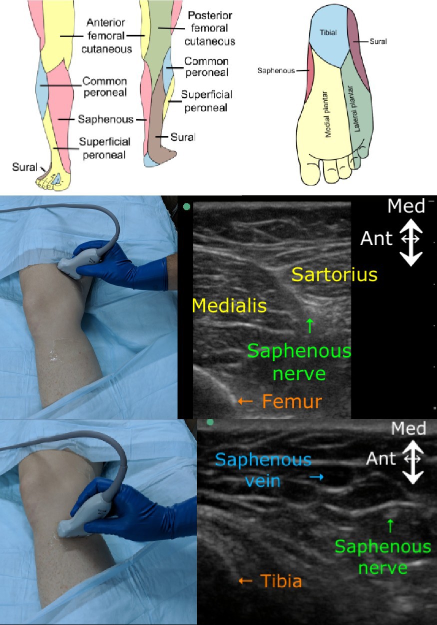 Saphenous Nerve Block Image