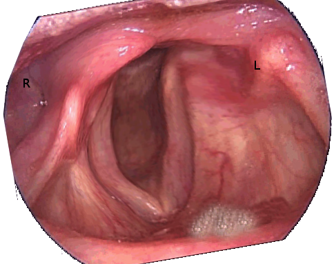 Unilateral vocal cord paralysis after a left parathyroidectomy