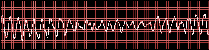 Ventricular fibrillation