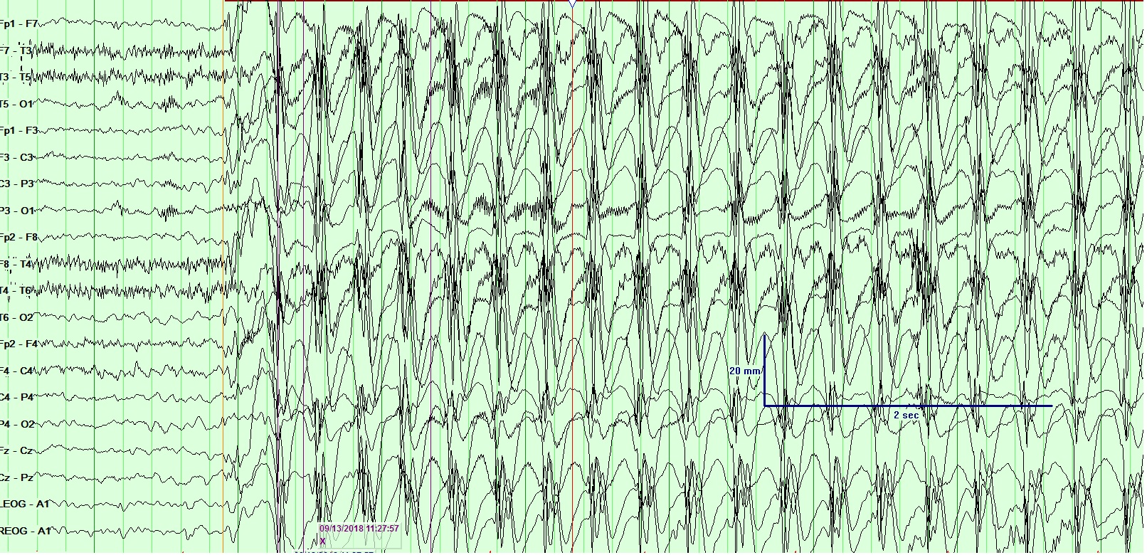 EEG - gen epileptiform