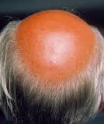 Photo showing male-pattern androgenetic alopecia