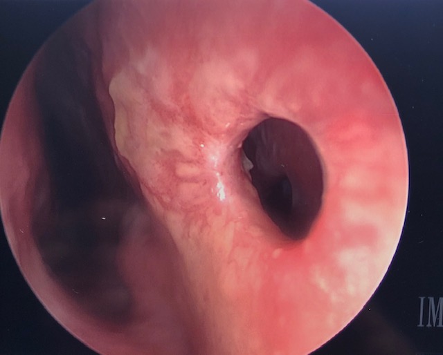 <p>Nasal Septal Perforation.</p>