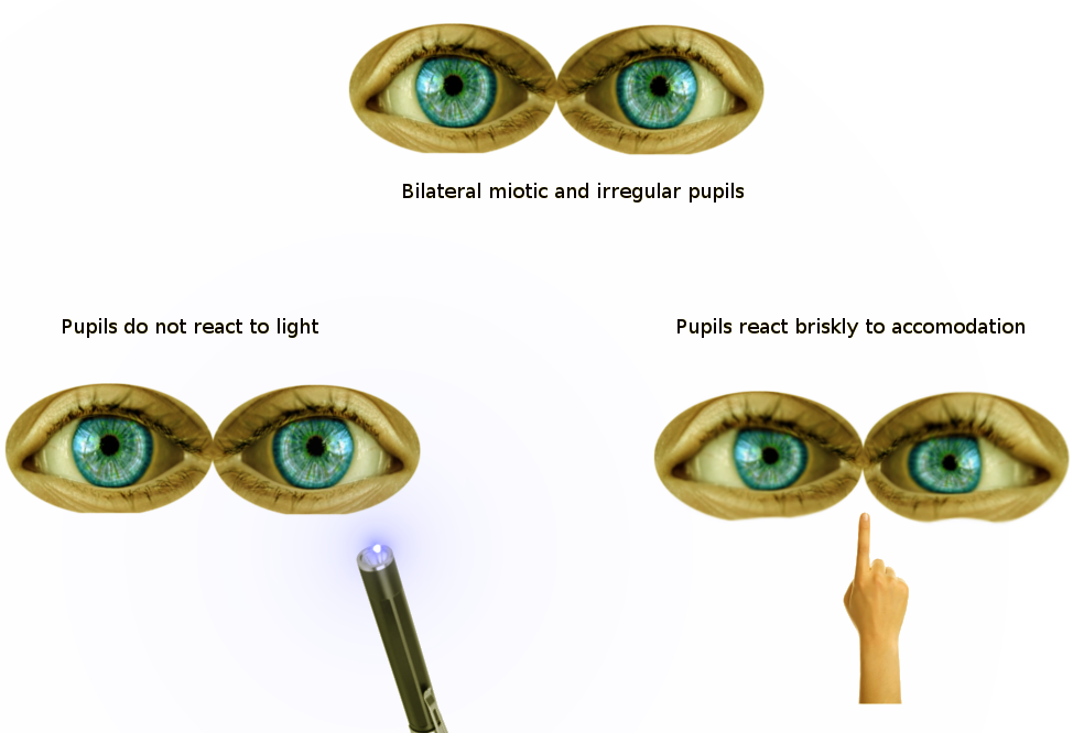 Argyll Robertson Pupils