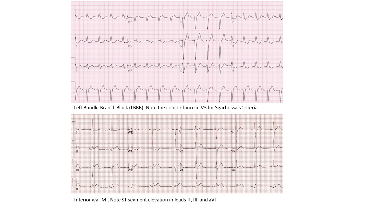 ECG- Left Bundle Branch Block and inferior wall MI