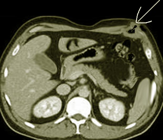 Richter hernia following laparoscopy