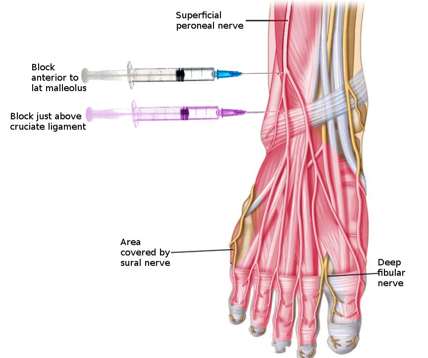 Superficial Peroneal Nerve block