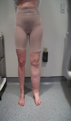 Secondary Lymphedema related to cervical cancer treatment