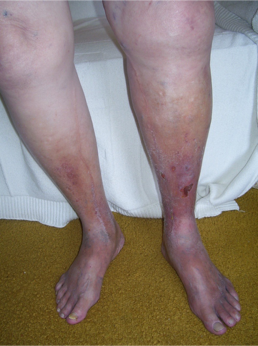 Chronic venous insufficiency