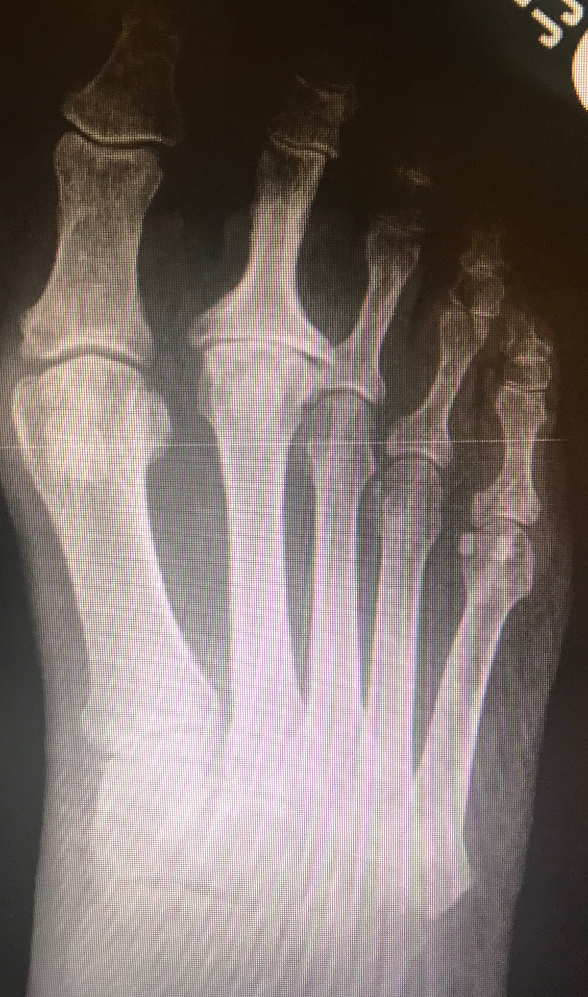 Dorsal-plantar radiograph of the foot with avascular necrosis of the second metatarsal head (Freibergs disease)