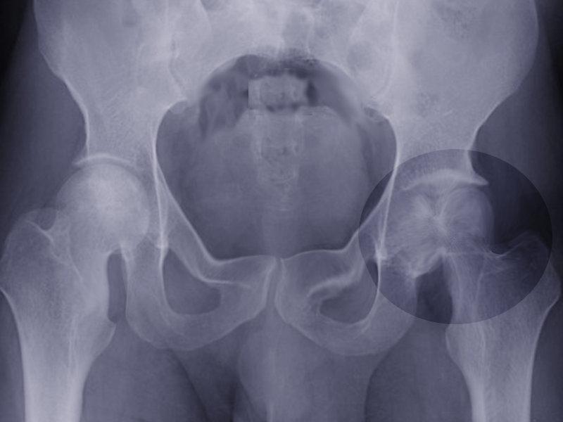 Severe AVN of hip