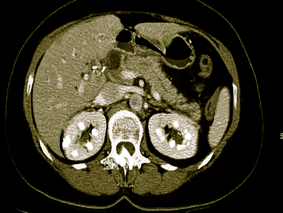 Nephrocalcinosis