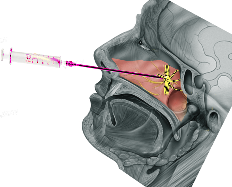 sphenopalatine ganglion