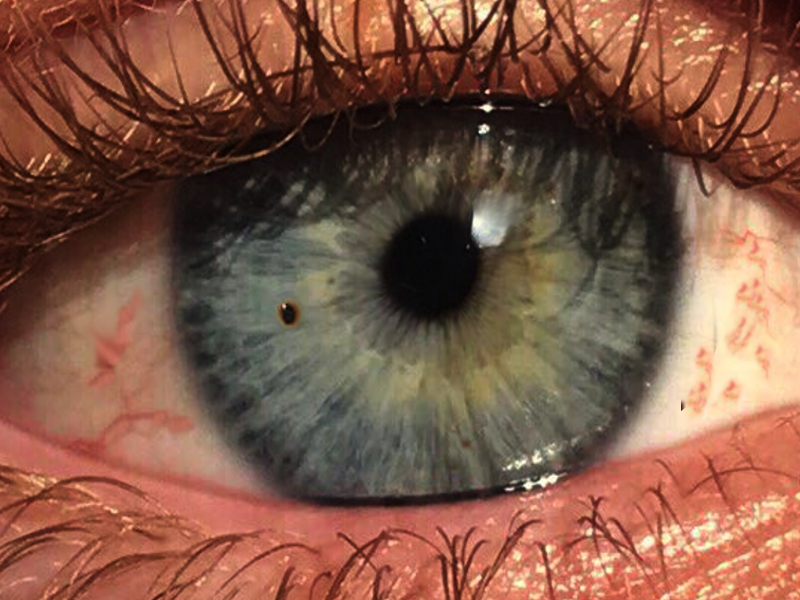 Corneal foreign body