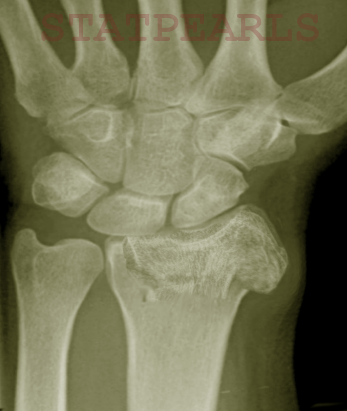 Distal radius Fx