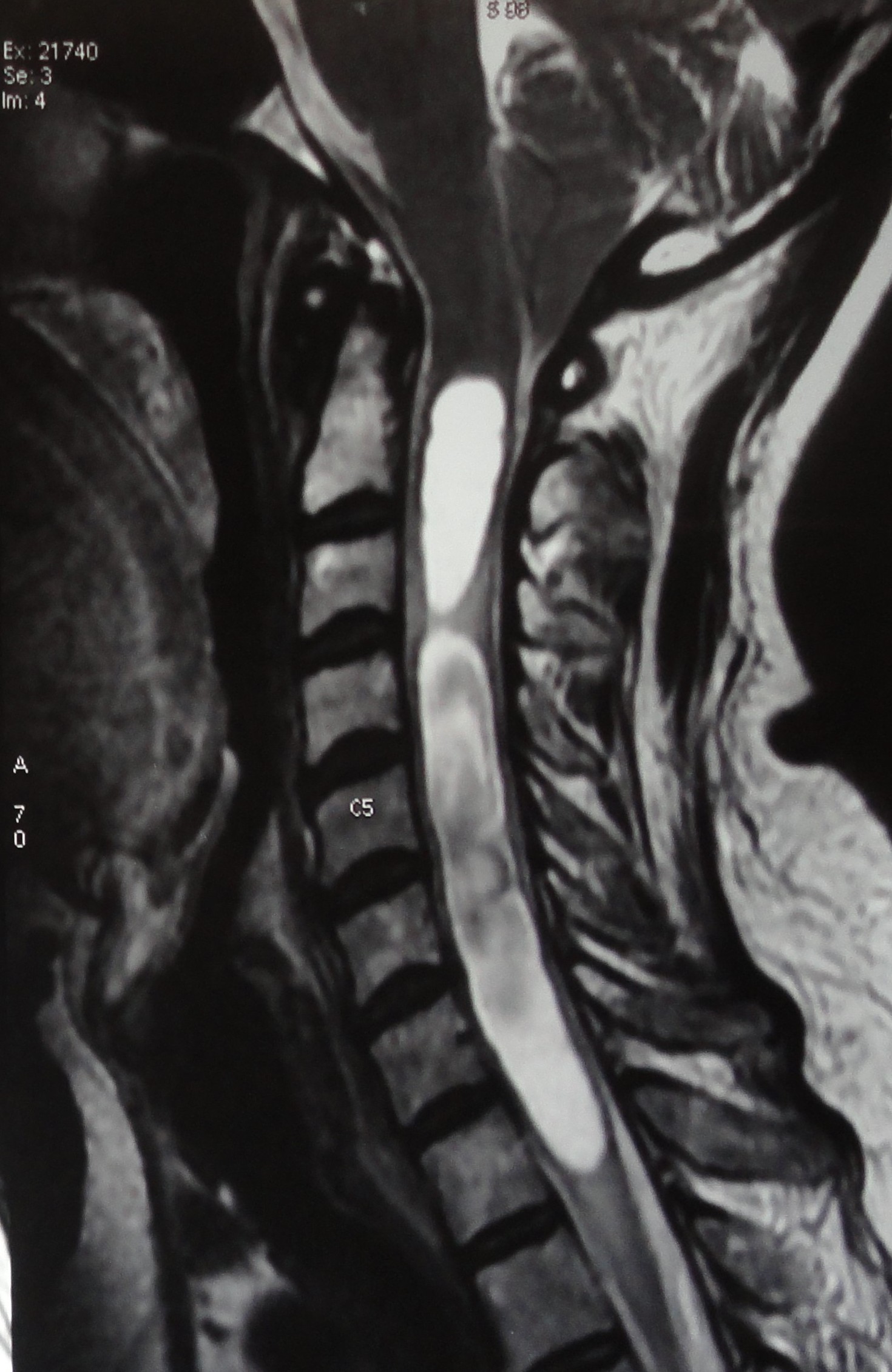 Syringomyelia in a patient with hindbrain herniation