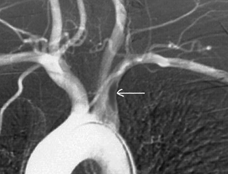 Subclavian artery thrombosis