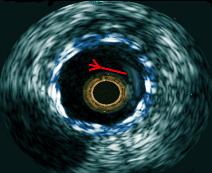 IVUS-in stent thrombosis