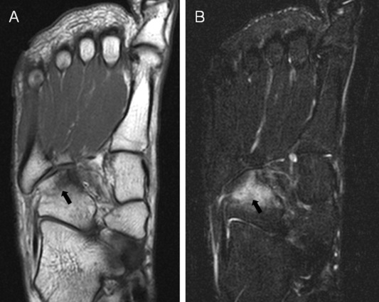 MRI image of increased signal (white areas) on the cuboid bone which indicates a stress fracture