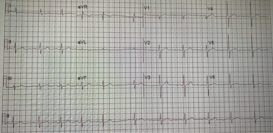 12 Lead EKG - Sinus Arrhythmia