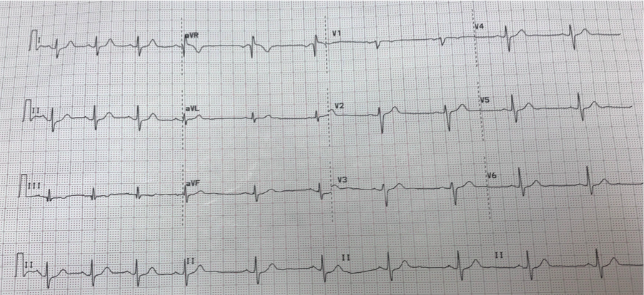 12 Lead EKG displaying Sinus Arrhythmia