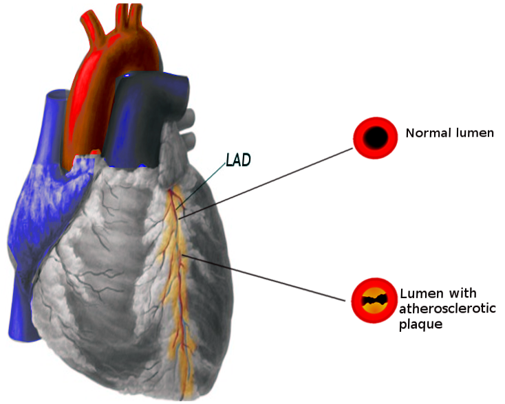 Coronary artery disease