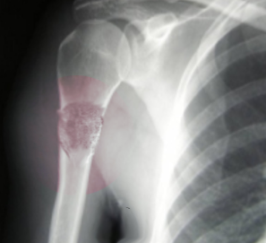 Telangiectactic osteosarcoma