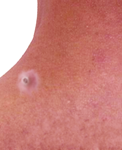 <p>Dilated Pore of Winer