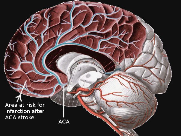 Anterior cerebral artery stroke