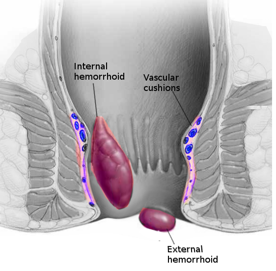 Hemorrhoids