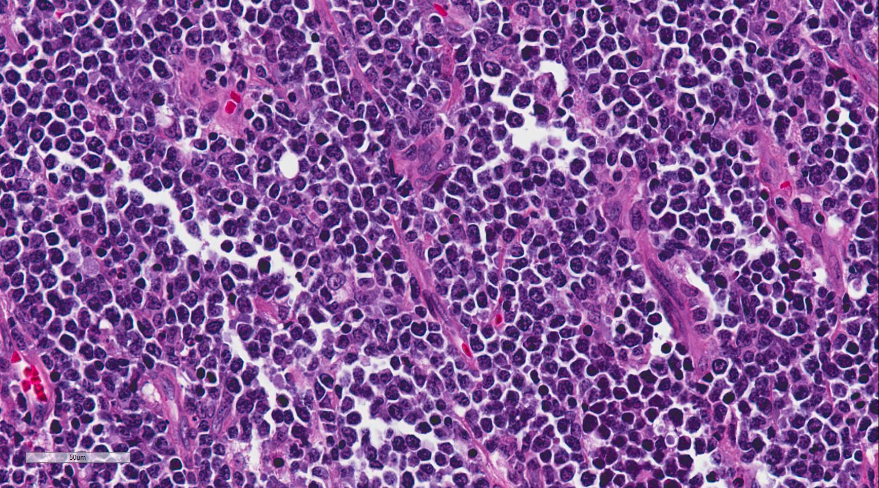 <p>Burkitt Lymphoma
