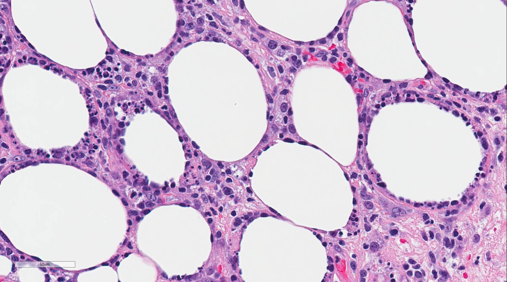 <p>Subcutaneous Panniculitis