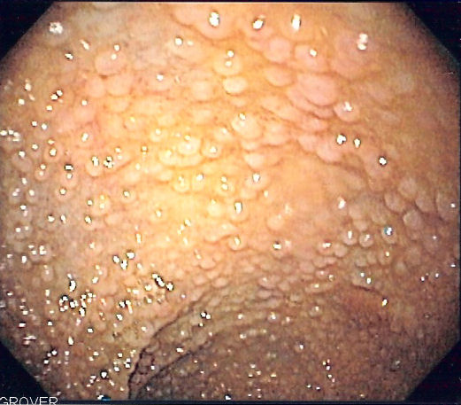 Familial adenomatous polyposis as seen on sigmoidoscopy