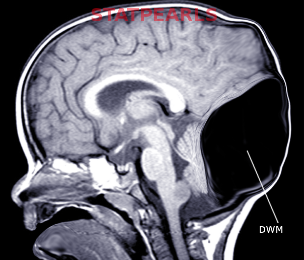 Dandy Walker Malformation