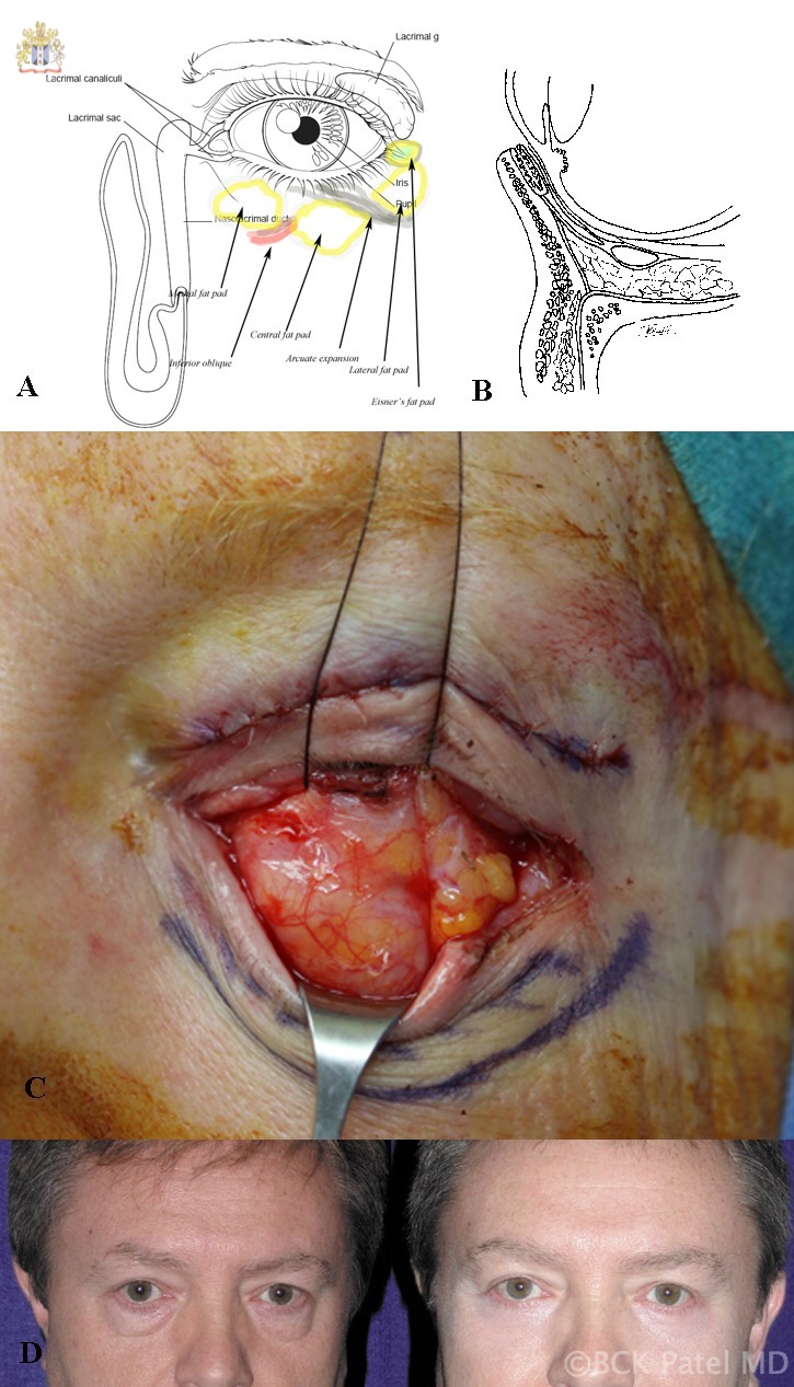 A: Surface anatomy of the left lower eyelid fat pads