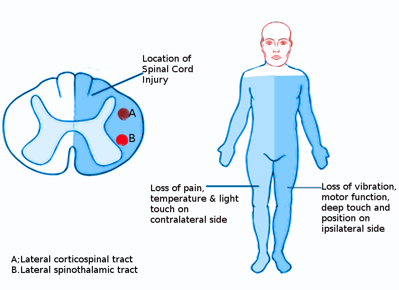 Brown Sequard Syndrome