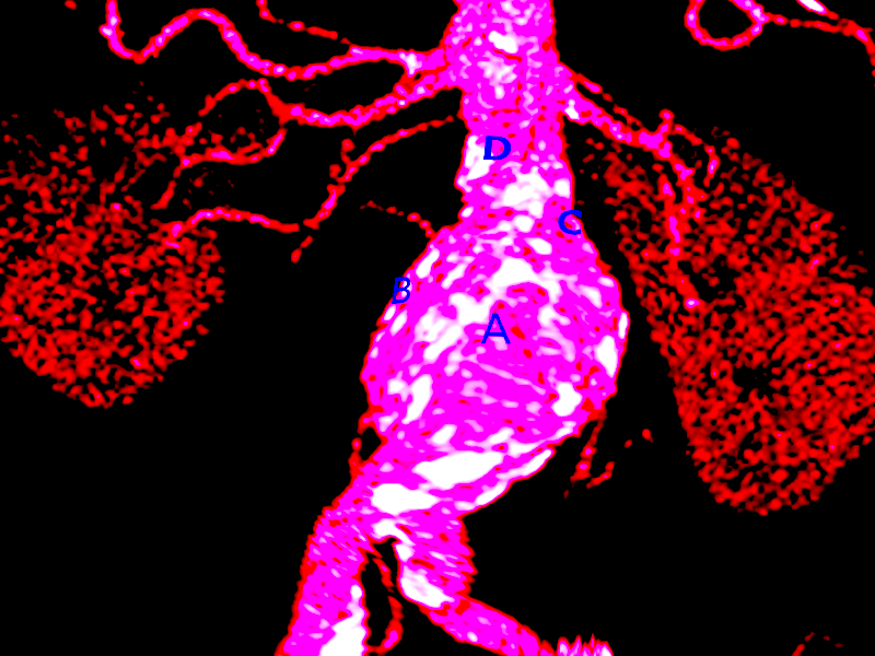 Abdominal aortic aneurysm