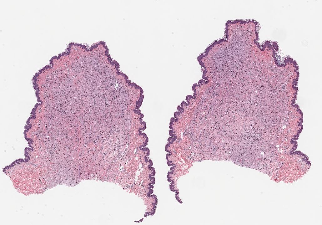 Neurofibroma, H&E stain, 10x magnification.