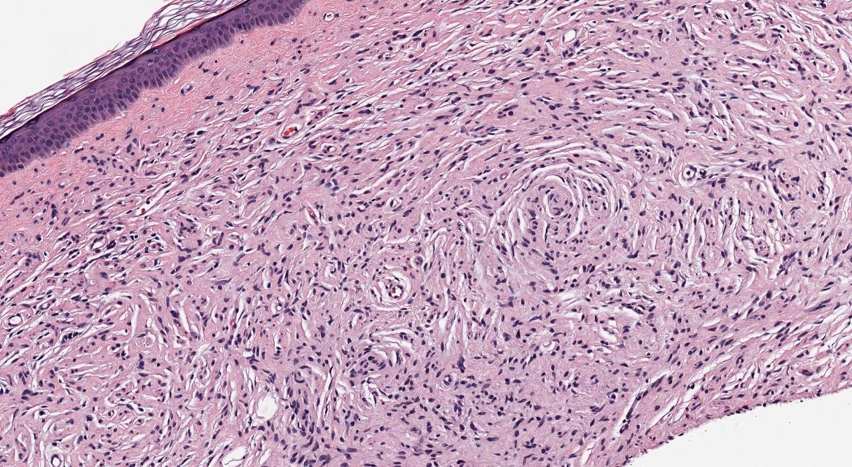 Neurofibroma, H&E stain, 100X magnification.