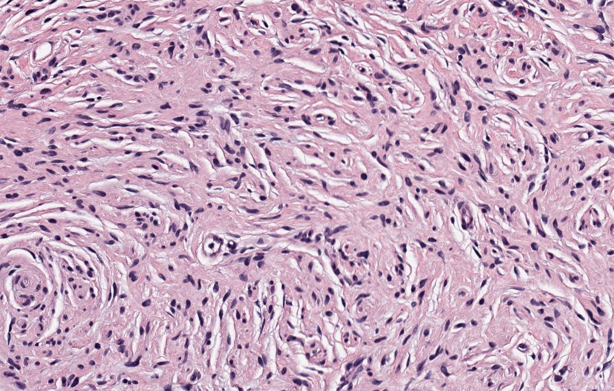 Neurofibroma, H&E stain, 200X magnification.