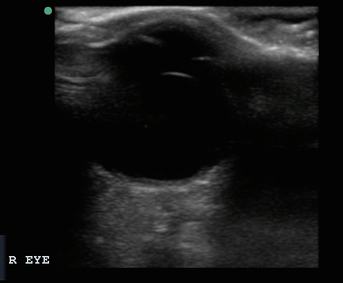 ocular ultrasound