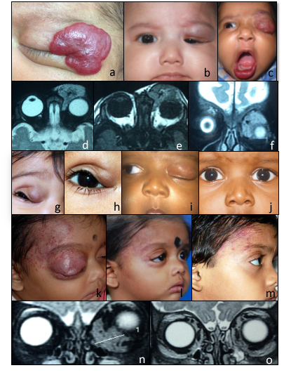 <p>Capillary Infantile Hemangiomas
