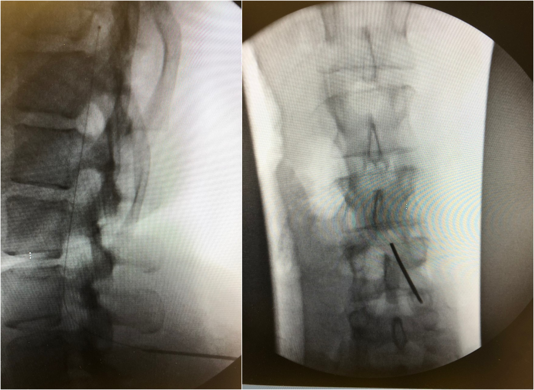 Left Image Intrathecal catheter lateral view:  fluoroscopic picture of catheter in intrathecal space

Right Image IT cathet