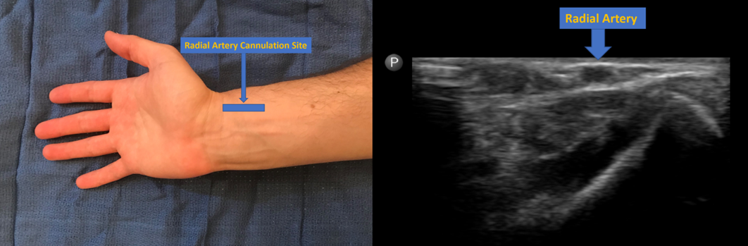 Radial artery cannulation site and image of radial artery on ultrasound at this level.