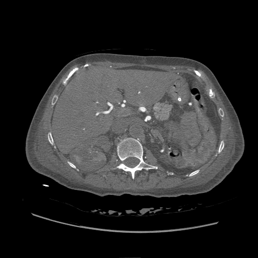 Aortic Thrombosis. Contrasted CT of abdomen.